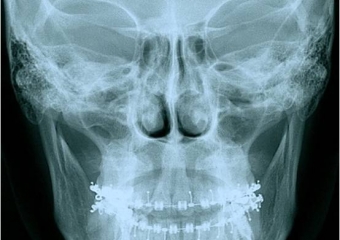 Telerradiografia frontal inicial - Clínica Cliniface