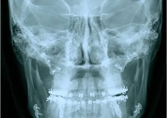 Telerradiografia frontal após a cirurgia - Clínica Cliniface