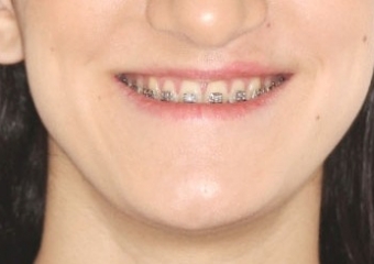 Sorriso inicial - Clínica Cliniface