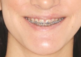 Sorriso após a cirurgia realizada em 2016 - Clínica Cliniface