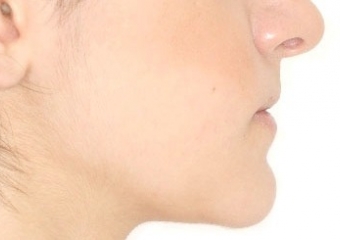 Perfil após a cirurgia realizada em 2016 - Clínica Cliniface