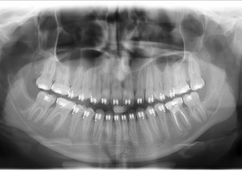 Rx Panoramico inicial - Clínica Cliniface