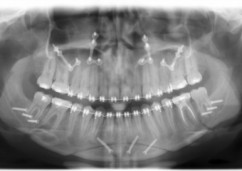 Rx Panoramico após a cirurgia  - Clínica Cliniface