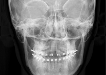 Telerradiografia frontal inicial  - Clínica Cliniface
