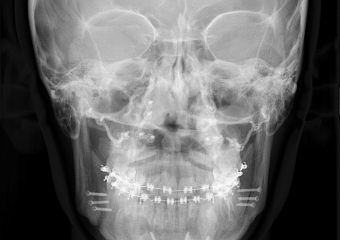 Telerradiografia frontal após a cirurgia - Clínica Cliniface