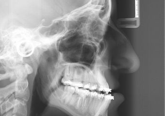 Telerradiografia perfil inicial - Clínica Cliniface
