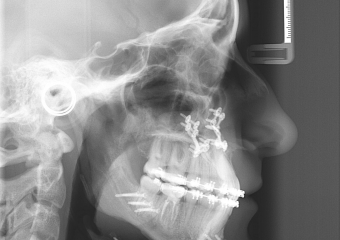 Telerradiografia perfil após a cirurgia  - Clínica Cliniface