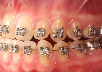 Mordida inicial - Clínica Cliniface
