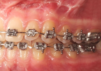 Mordida após a cirurgia - Clínica Cliniface