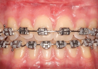 Mordida após a cirurgia realizada em 2016 - Clínica Cliniface