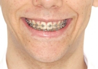 Sorriso após cirurgia realizada em 2015 - Clínica Cliniface