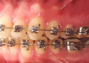 Mordida após cirurgia realizada em 2015 - Clínica Cliniface