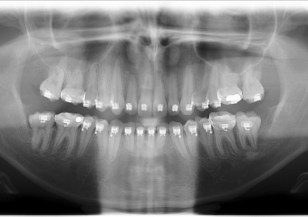Rx Panorâmico inicial  - Clínica Cliniface