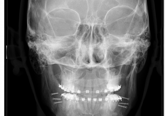 Telerradiografia frontal após cirurgia realizada em 2015 - Clínica Cliniface