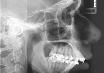 Telerradiografia perfil inicial - Clínica Cliniface