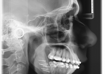 Telerradiografia perfil após cirurgia realizada em 2015 - Clínica Cliniface