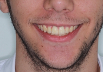 Sorriso após a cirurgia (Controle de 1 ano e 5 meses) - Clínica Cliniface