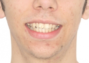 Sorriso inicial - Clínica Cliniface