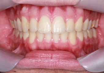 Mordida após cirurgia (Controle de 1 anos e 5 meses) - Clínica Cliniface