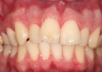 Mordida inicial - Clínica Cliniface