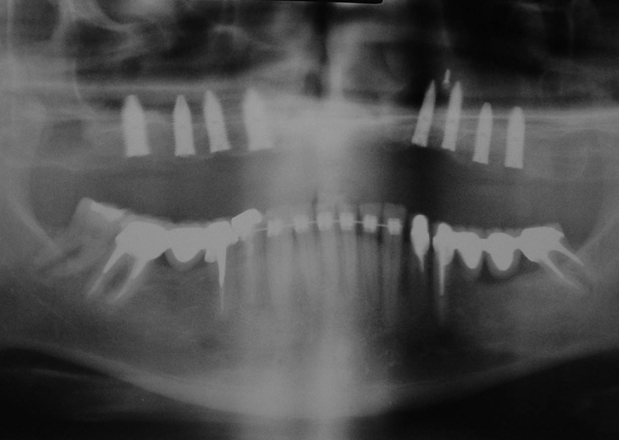 Raio X com 08 implantes Cone Morse instalados na maxila - Clínica Cliniface