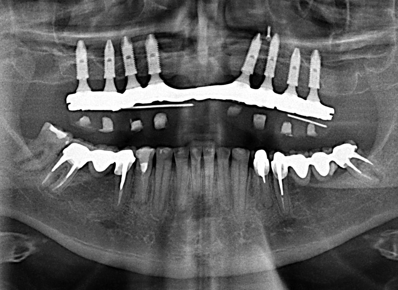 Raio X com a prótese fixa em resina instalada sobre implantes Cone Morse - Clínica Cliniface