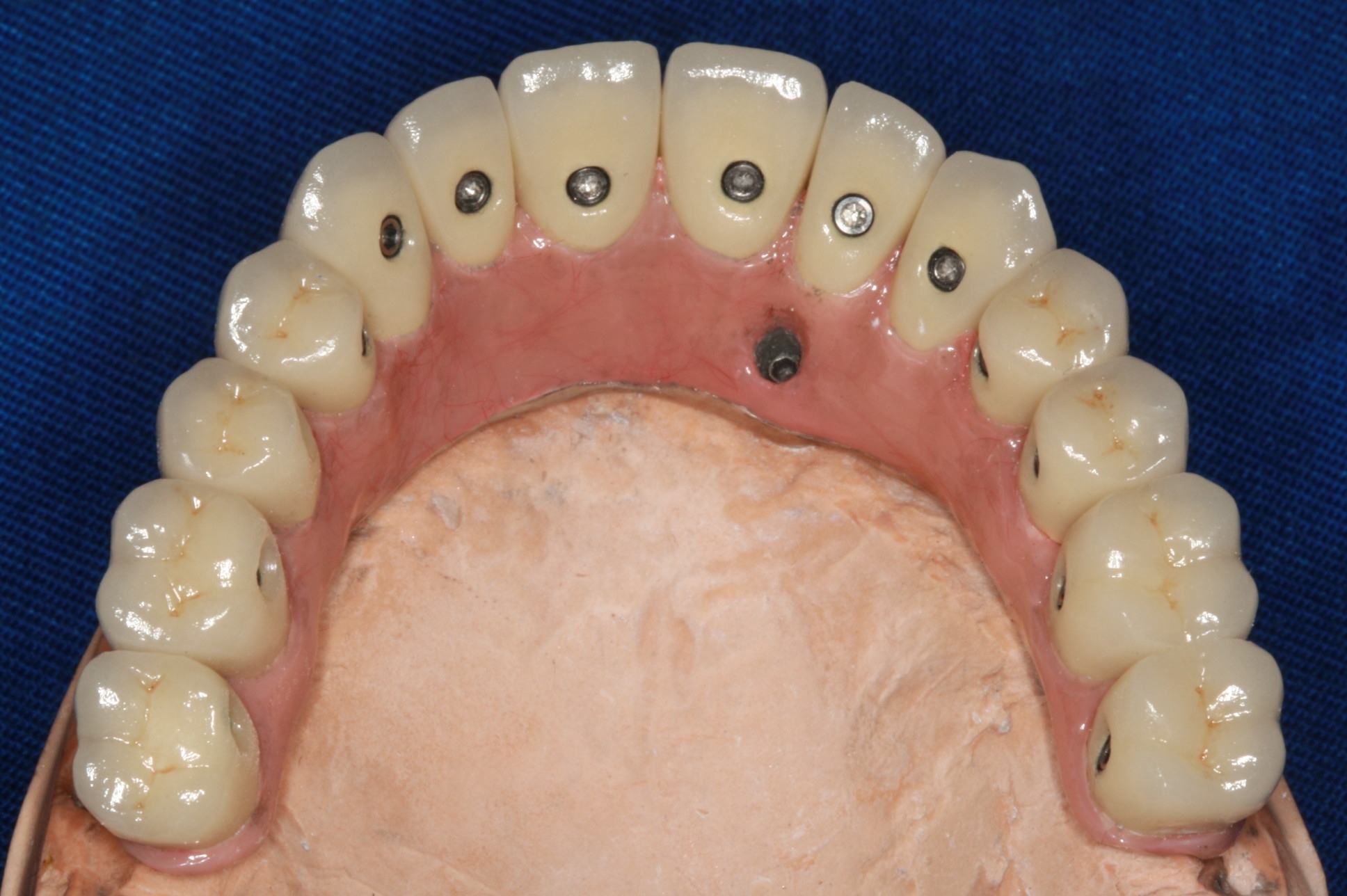 Prótese com dentes individuais no laboratório  - Clínica Cliniface