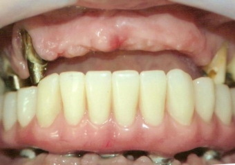 Implantes inferiores e prótese provisória inferior em Junho de 2014 - Clínica Cliniface