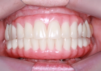 Próteses fixas definitivas em resina em Outubro de 2016 - Clínica Cliniface