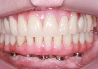 Próteses Fixas Provisórias em Setembro de 2015 - Clínica Cliniface