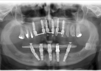 Raio - x Próteses Fixas provisórias em Fevereiro de 2016 - Clínica Cliniface