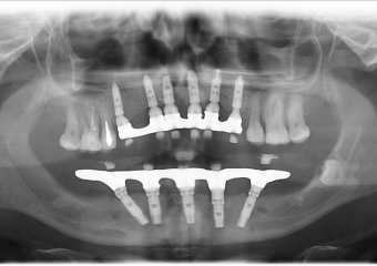 Raio - x Próteses Definitivas em Outubro de 2016  - Clínica Cliniface