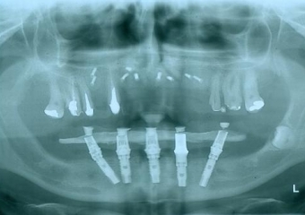 Enxerto ósseo maxila em Setembro de 2014 - Clínica Cliniface