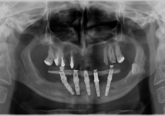Raio - x com implantes inferiores em Junho de 2014  - Clínica Cliniface