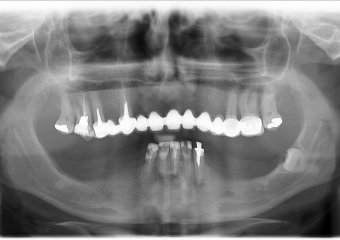 Raio -x inicial em 2014 - Clínica Cliniface