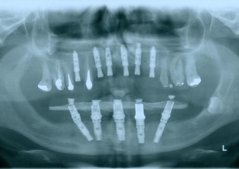 Raio-x Implantes Superiores em Julho de 2015 - Clínica Cliniface