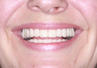 Sorriso Final em 2016 - Clínica Cliniface