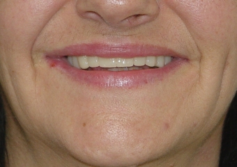 Sorriso inicial em 2014 - Clínica Cliniface