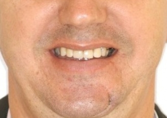 Sorriso inicial em 2009 - Clínica Cliniface