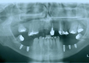 Raio - x implantes inferiores em Junho de 2011  - Clínica Cliniface