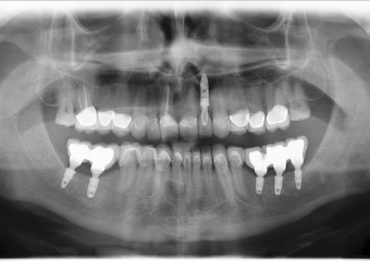Imagem Próteses Definitivas em Setembro de 2016 - Clínica Cliniface