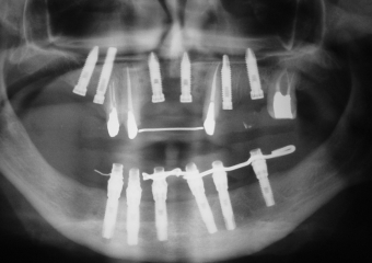 Imagem implantes Superiores em 2009 - Clínica Cliniface