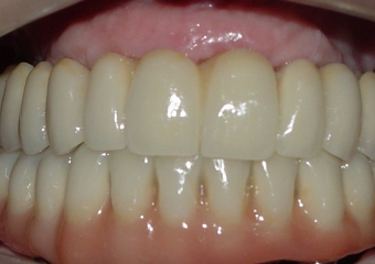 Próteses Fixas Definitivas em Porcelana, em 2013 - Clínica Cliniface