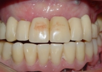 Prótese Provisória Fixa Inferior em 2009  - Clínica Cliniface