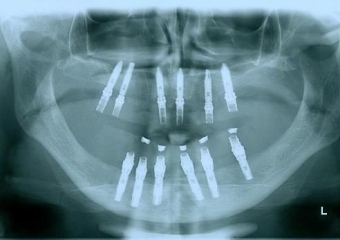 Imagem Próteses Provisórias Fixas Superior e Inferior , em 2011 - Clínica Cliniface