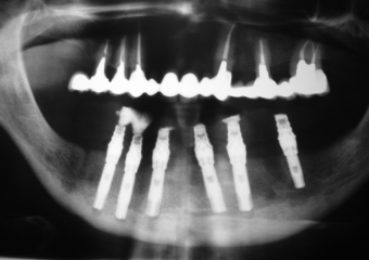 Imagem implantes inferiores em 2006 - Clínica Cliniface
