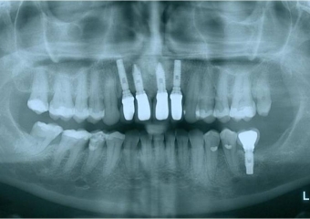 Raio X de controle, realizado em abril de 2013 - Clínica Cliniface
