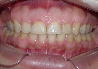 Mordida final - Clínica Cliniface
