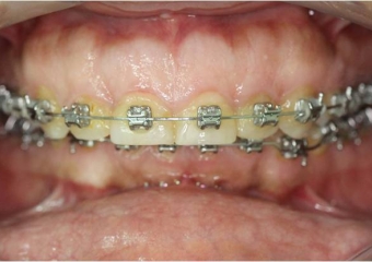 Mordida inicial - Clínica Cliniface