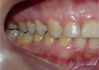 Mordida final - Clínica Cliniface